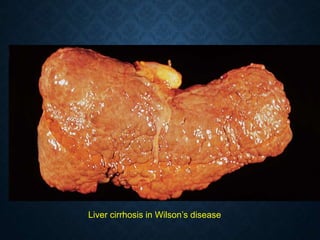 Liver cirrhosis in Wilson’s disease
 