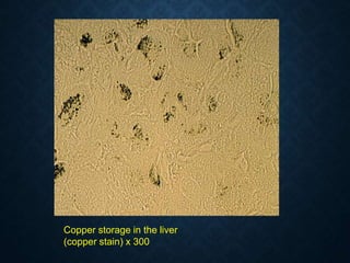 Copper storage in the liver
(copper stain) x 300
 