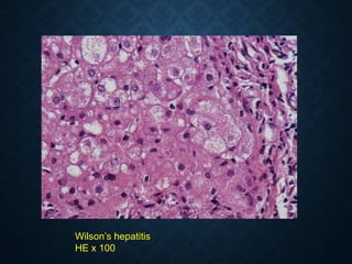Wilson’s hepatitis
HE x 100
 
