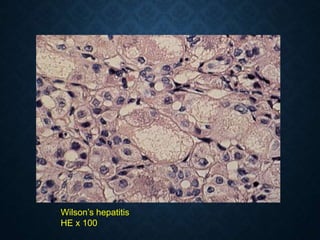 Wilson’s hepatitis
HE x 100
 