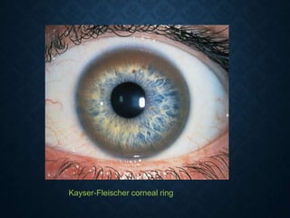 Kayser-Fleischer corneal ring
 