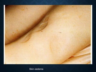 Skin oedema
 