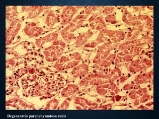 Degeneratio parenchymatosa renis
 