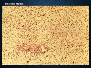 Steatosis hepatis
 