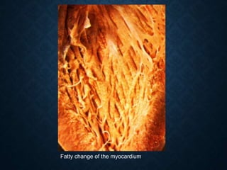 Fatty change of the myocardium
 