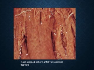 Tiger-stripped pattern of fatty myocardial
deposits
 