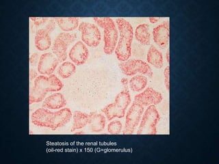 Steatosis of the renal tubules
(oil-red stain) x 150 (G=glomerulus)
 