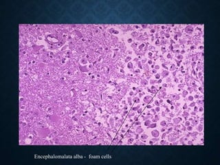 Encephalomalata alba - foam cells
 