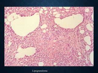 Lipogranuloma
 