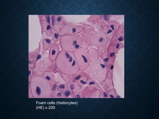 Foam cells (histiocytes)
(HE) x 200
 