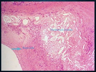 Foam cells
Cholesterol crystals
 