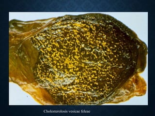 Cholesterolosis vesicae feleae
 