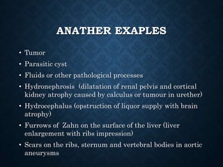 ANATHER EXAPLES
• Tumor
• Parasitic cyst
• Fluids or other pathological processes
• Hydronephrosis (dilatation of renal pelvis and cortical
kidney atrophy caused by calculus or tumour in urether)
• Hydrocephalus (opstruction of liquor supply with brain
atrophy)
• Furrows of Zahn on the surface of the liver (liver
enlargement with ribs impression)
• Scars on the ribs, sternum and vertebral bodies in aortic
aneurysms
 