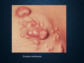 Eruptive xanthomas
 