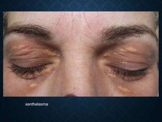 xanthelasma
 
