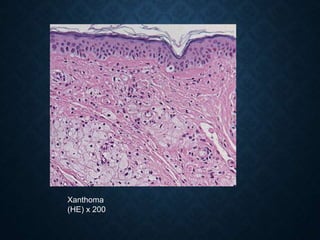 Xanthoma
(HE) x 200
 