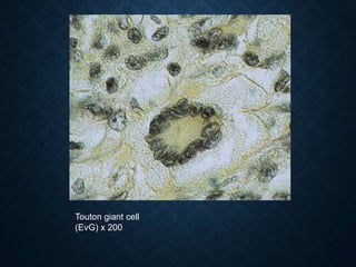 Touton giant cell
(EvG) x 200
 