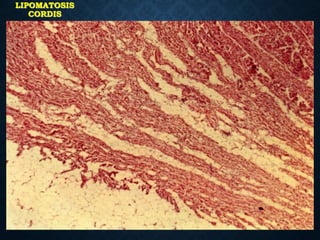 LIPOMATOSIS
CORDIS
 