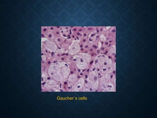 Gaucher`s cells
 