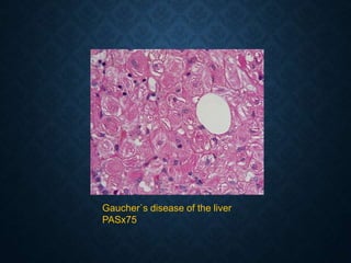 Gaucher`s disease of the liver
PASx75
 