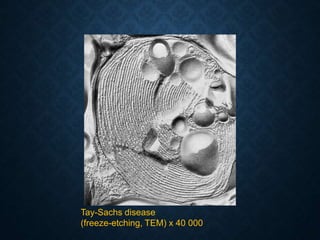 Tay-Sachs disease
(freeze-etching, TEM) x 40 000
 