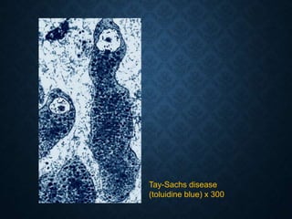 Tay-Sachs disease
(toluidine blue) x 300
 