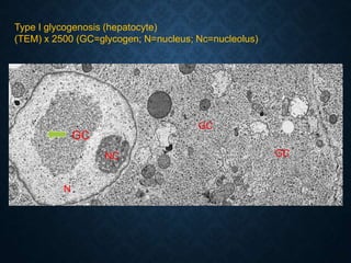 Type I glycogenosis (hepatocyte)
(TEM) x 2500 (GC=glycogen; N=nucleus; Nc=nucleolus)
GC
GC
GC
N
NC
 