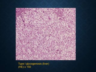 Type I glycogenosis (liver)
(HE) x 150
 
