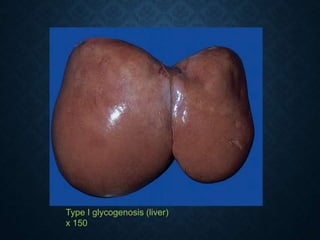 Type I glycogenosis (liver)
x 150
 