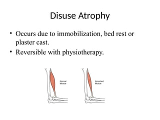 Atrophy_PPT_Physiotherapy.pptx.................. | PPTX
