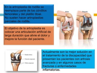 En la artroplastia de rodilla se
reemplaza parte de los cóndilos
femorales y del platillo tibial.
No suelen hacer artroplastias
parciales de rodilla.
El objetivo de la artroplastia es
colocar una articulación artificial de
larga duración que alivie el dolor y
mejore la función del paciente.

Actualmente son la mejor solución en
el tratamiento de la discapacidad que
presentan los pacientes con artrosis
avanzada y en algunos casos de
fracturas o enfermedades
inflamatorias.

 
