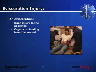 Emergency Medical Technician
22 - Abdominal Emergencies
© 2014
• An evisceration:
– Open injury to the
abdomen
– Organs protruding
from the wound
51
 