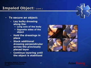 Emergency Medical Technician
22 - Abdominal Emergencies
© 2014
• To secure an object:
– Lay bulky dressing
along the:
 Long axis of the body
 Opposite sides of the
object
– Hold the dressings in
place
– Stack additional
dressing perpendicular
across the previously
placed layer
– Continue layering until
the object is stabilized
57
 
