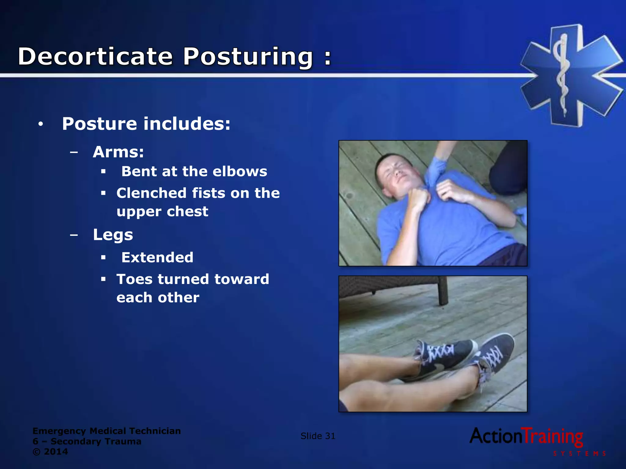 Emergency Medical Technician
6 – Secondary Trauma
© 2014
Slide 31
• Posture includes:
– Arms:
 Bent at the elbows
 Clenched fists on the
upper chest
– Legs
 Extended
 Toes turned toward
each other
 