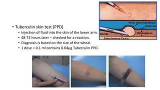 • Tuberculin skin test (PPD)
• Injection of fluid into the skin of the lower arm.
• 48-72 hours later – checked for a reaction.
• Diagnosis is based on the size of the wheal.
• 1 dose = 0.1 ml contains 0.04μg Tuberculin PPD.
 