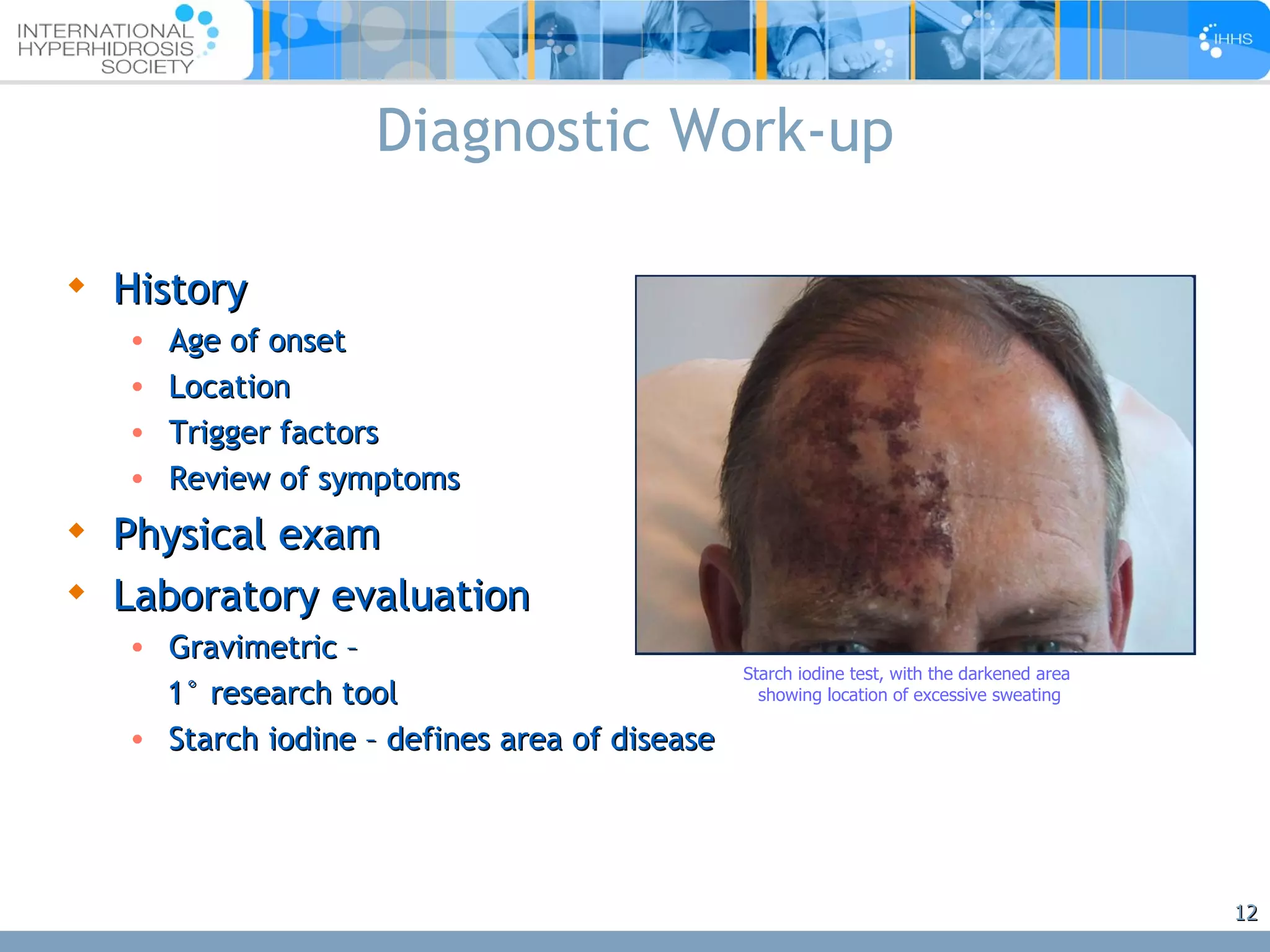 Diagnostic Work-up History Age of onset Location Trigger factors Review of symptoms Physical exam Laboratory evaluation Gravimetric – 1 °  research tool Starch iodine – defines area of disease Starch iodine test, with the darkened area  showing location of excessive sweating 