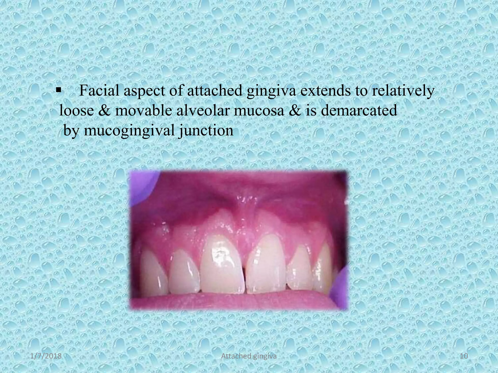  Facial aspect of attached gingiva extends to relatively
loose & movable alveolar mucosa & is demarcated
by mucogingival junction
1/7/2018 Attached gingiva 10
 