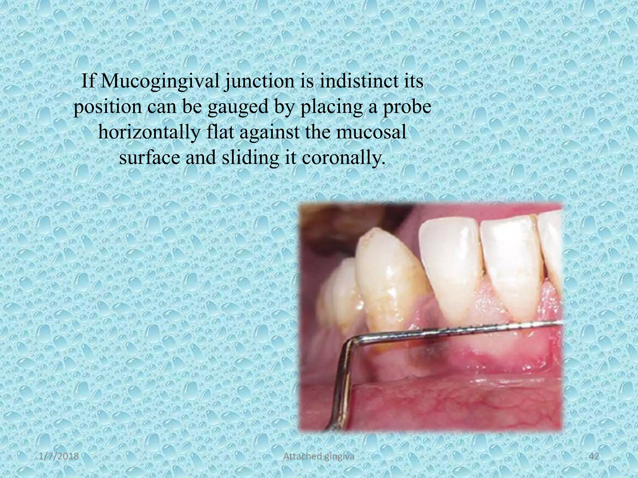 1/7/2018 Attached gingiva 42
If Mucogingival junction is indistinct its
position can be gauged by placing a probe
horizontally flat against the mucosal
surface and sliding it coronally.
 