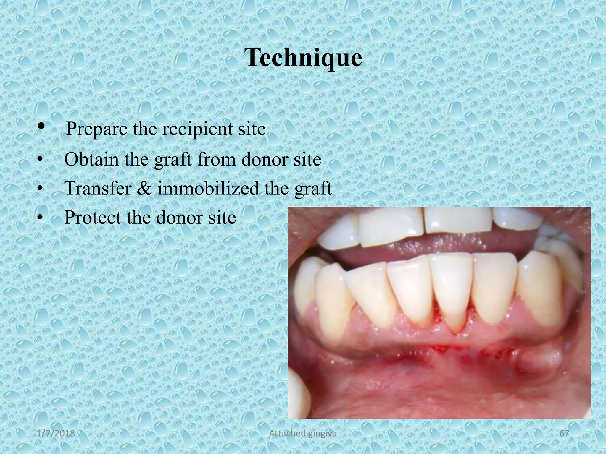 Technique
• Prepare the recipient site
• Obtain the graft from donor site
• Transfer & immobilized the graft
• Protect the donor site
1/7/2018 Attached gingiva 67
 