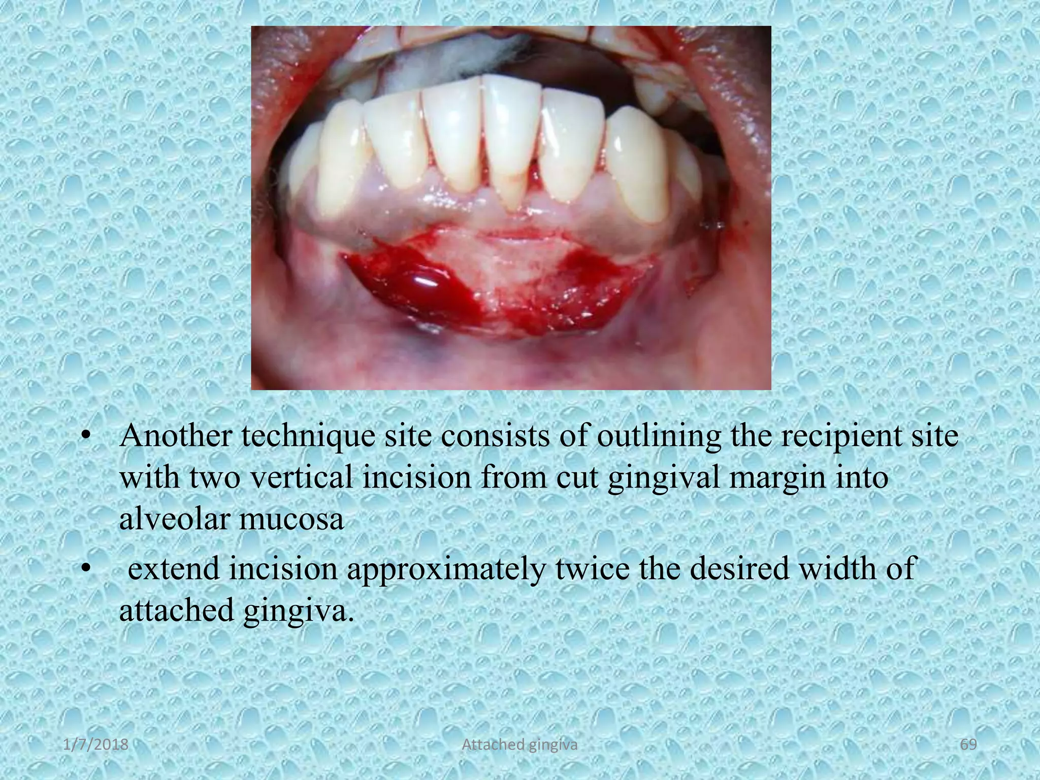 1/7/2018 Attached gingiva 69
• Another technique site consists of outlining the recipient site
with two vertical incision from cut gingival margin into
alveolar mucosa
• extend incision approximately twice the desired width of
attached gingiva.
 