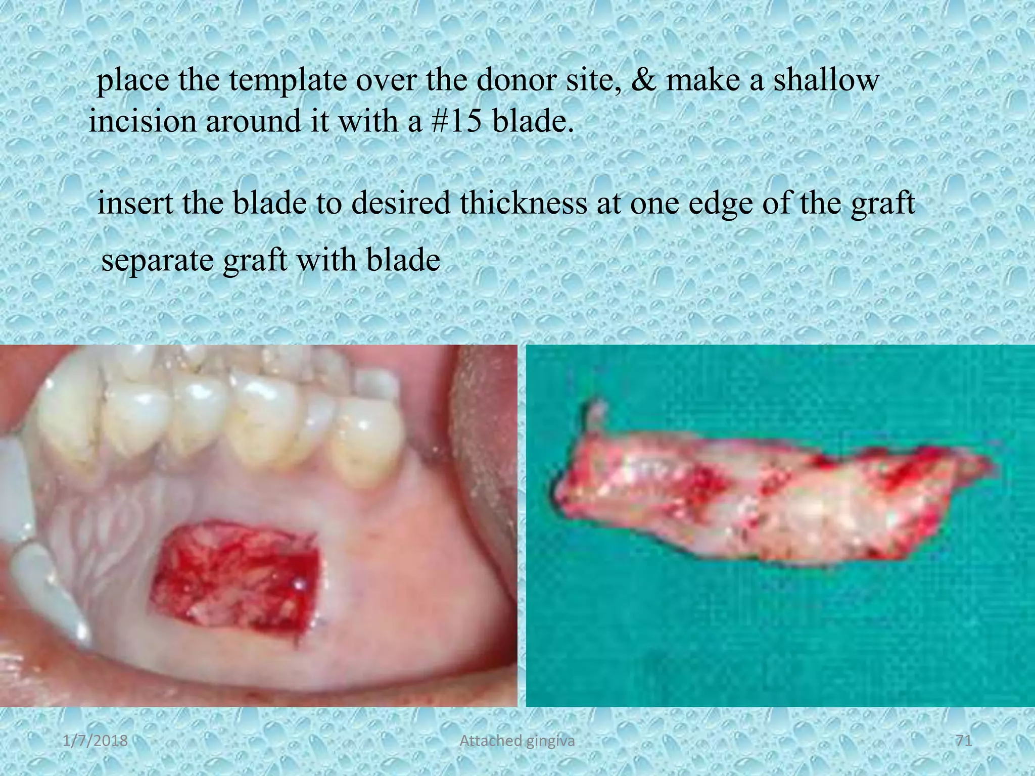 1/7/2018 Attached gingiva 71
separate graft with blade
place the template over the donor site, & make a shallow
incision around it with a #15 blade.
insert the blade to desired thickness at one edge of the graft
 