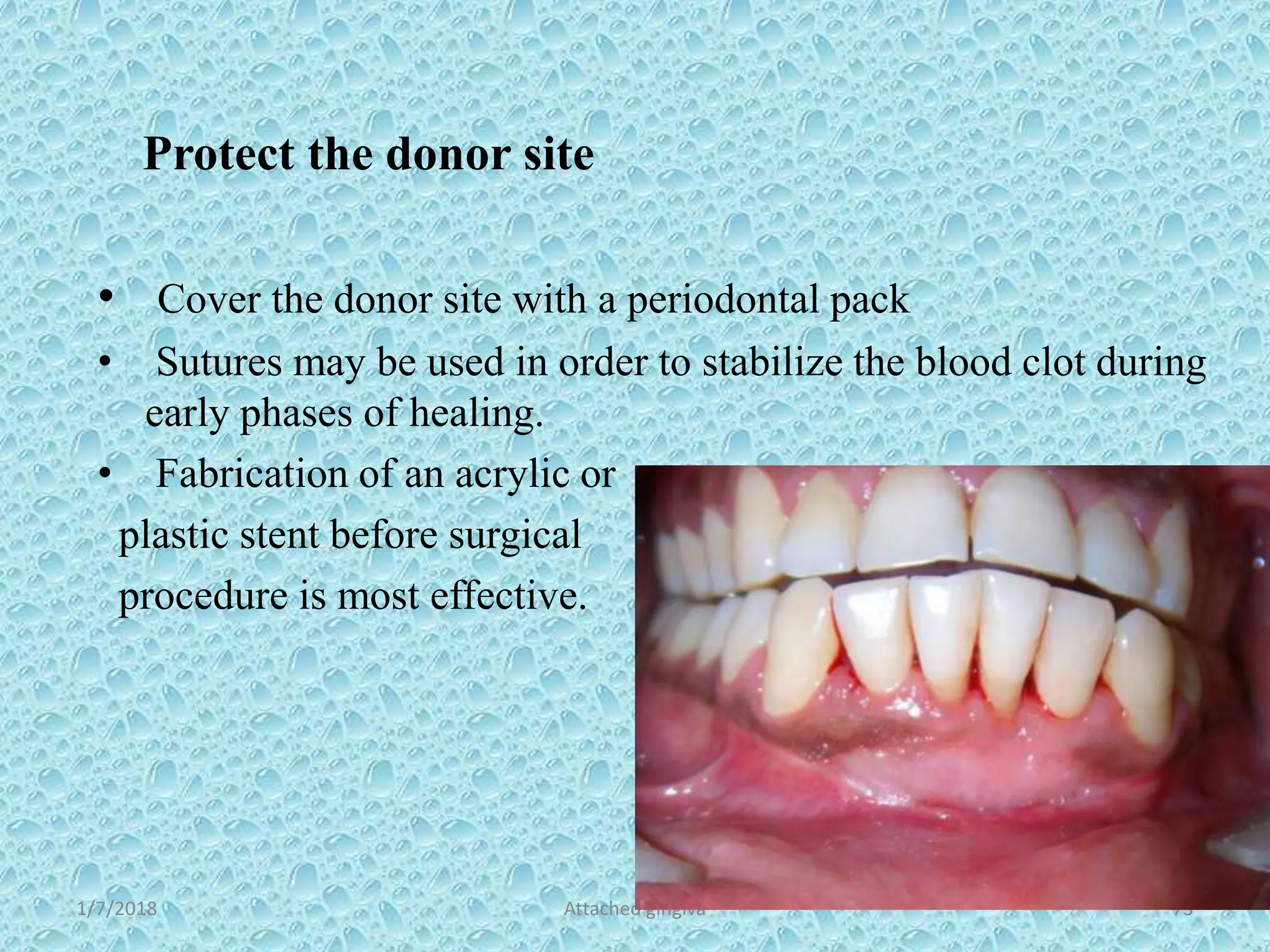 1/7/2018 Attached gingiva 73
Protect the donor site
• Cover the donor site with a periodontal pack
• Sutures may be used in order to stabilize the blood clot during
early phases of healing.
• Fabrication of an acrylic or
plastic stent before surgical
procedure is most effective.
 