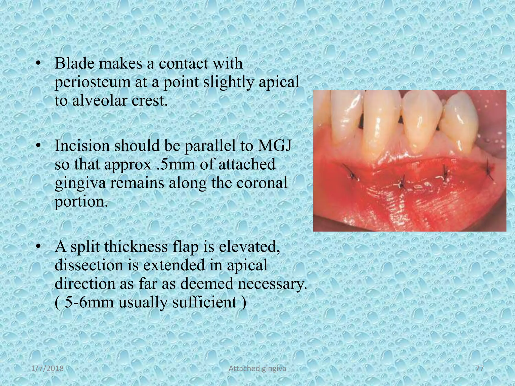 1/7/2018 Attached gingiva 77
• Blade makes a contact with
periosteum at a point slightly apical
to alveolar crest.
• Incision should be parallel to MGJ
so that approx .5mm of attached
gingiva remains along the coronal
portion.
• A split thickness flap is elevated,
dissection is extended in apical
direction as far as deemed necessary.
( 5-6mm usually sufficient )
 