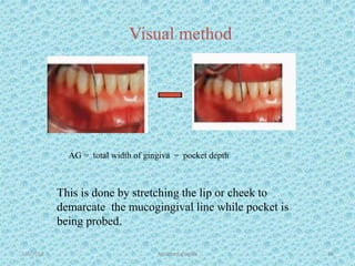 1/7/2018 Attached gingiva 38
Visual method
AG = total width of gingiva ̶ pocket depth
This is done by stretching the lip or cheek to
demarcate the mucogingival line while pocket is
being probed.
 