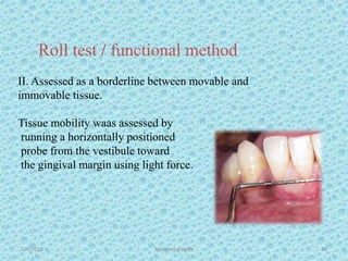 1/7/2018 Attached gingiva 39
Roll test / functional method
II. Assessed as a borderline between movable and
immovable tissue.
Tissue mobility waas assessed by
running a horizontally positioned
probe from the vestibule toward
the gingival margin using light force.
 