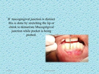 1/7/2018 Attached gingiva 41
If mucogingival junction is distinct
this is done by stretching the lip or
cheek to demarcate Mucogingival
junction while pocket is being
probed.
 