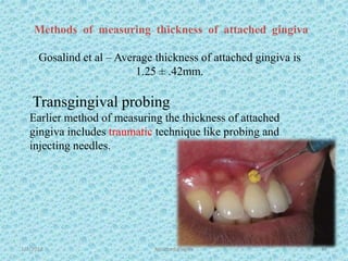 1/7/2018 Attached gingiva 43
Methods of measuring thickness of attached gingiva
Gosalind et al – Average thickness of attached gingiva is
1.25 ± .42mm.
Transgingival probing
Earlier method of measuring the thickness of attached
gingiva includes traumatic technique like probing and
injecting needles.
 