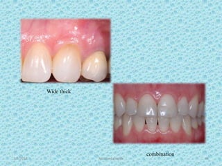 1/7/2018 Attached gingiva 48
Wide thick
combination
 