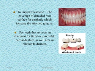 1/7/2018 Attached gingiva 58
To improve aesthetic – The
coverage of denuded root
surface for aesthetic which
increase the attached gingiva.
For teeth that serve as an
abutment for fixed or removable
partial denture, as well area in
relation to denture.
 