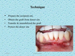 Technique
• Prepare the recipient site
• Obtain the graft from donor site
• Transfer & immobilized the graft
• Protect the donor site
1/7/2018 Attached gingiva 67
 